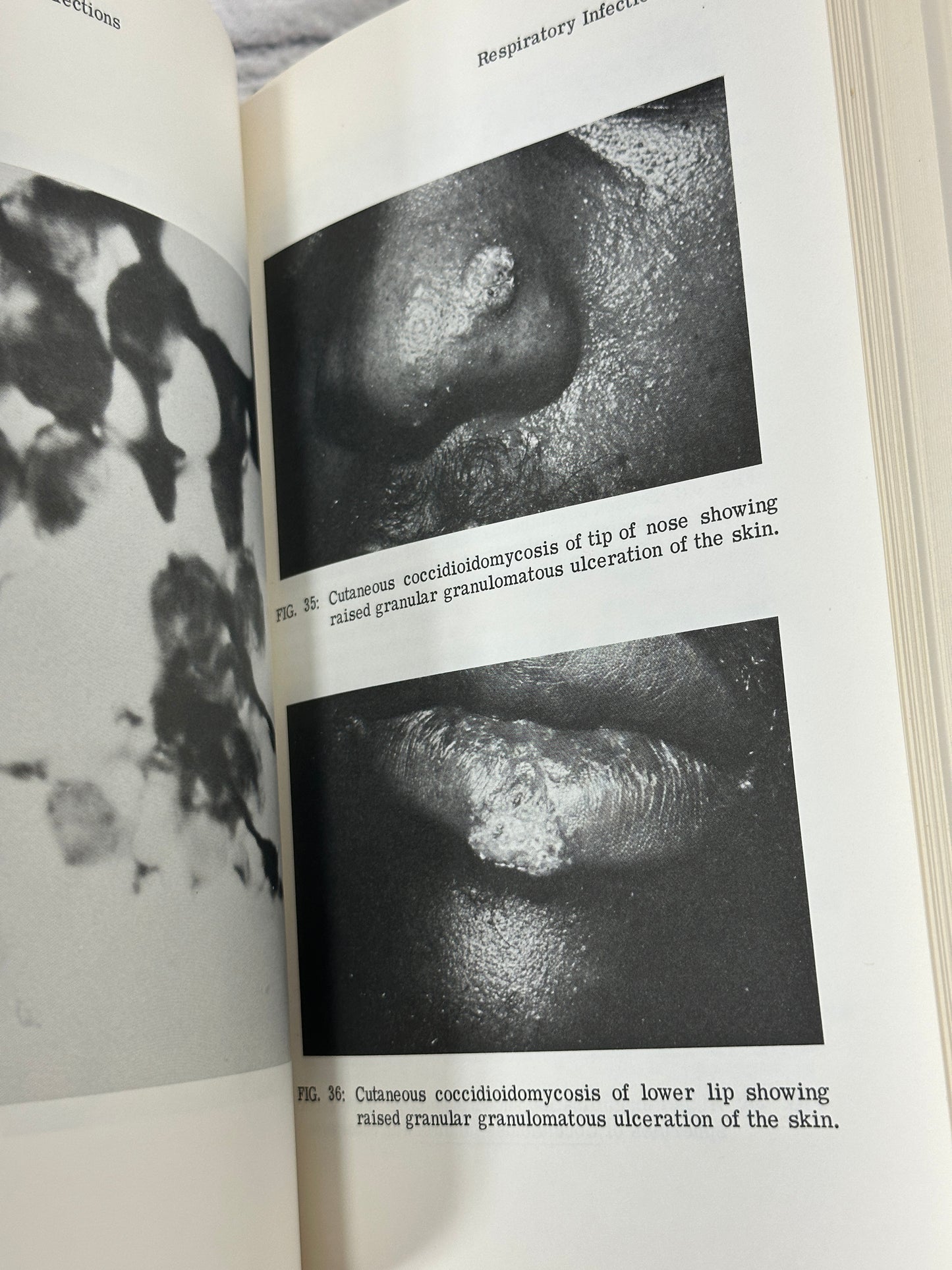 Infectious Diseases: Focus on Clinical Diagnosis by Haragopal Thadepalli [1980]