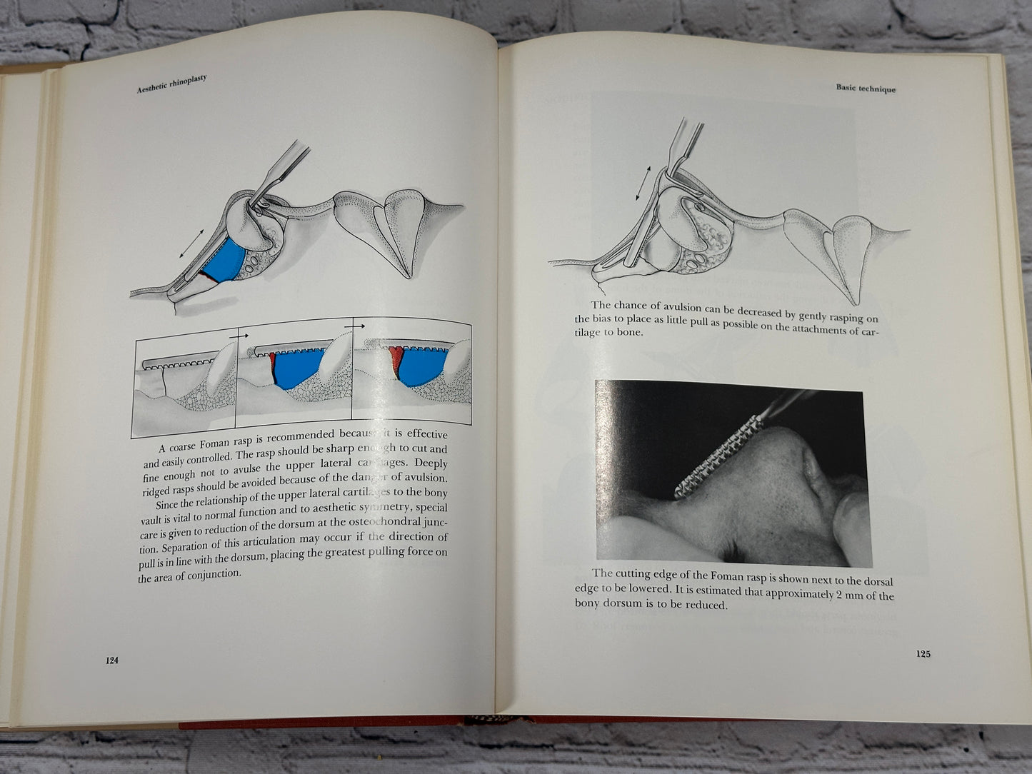 Aesthetic Rhinoplasty By Jack H Sheen [First Print · 1978]