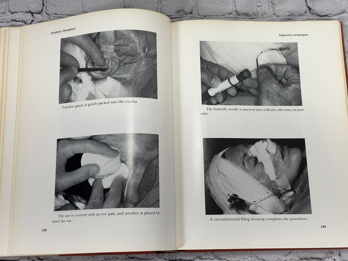 Aesthetic Rhinoplasty By Jack H Sheen [First Print · 1978]