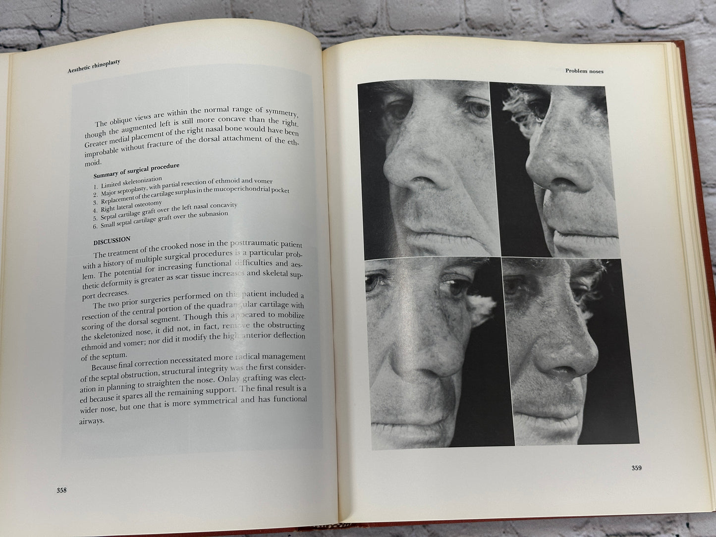 Aesthetic Rhinoplasty By Jack H Sheen [First Print · 1978]