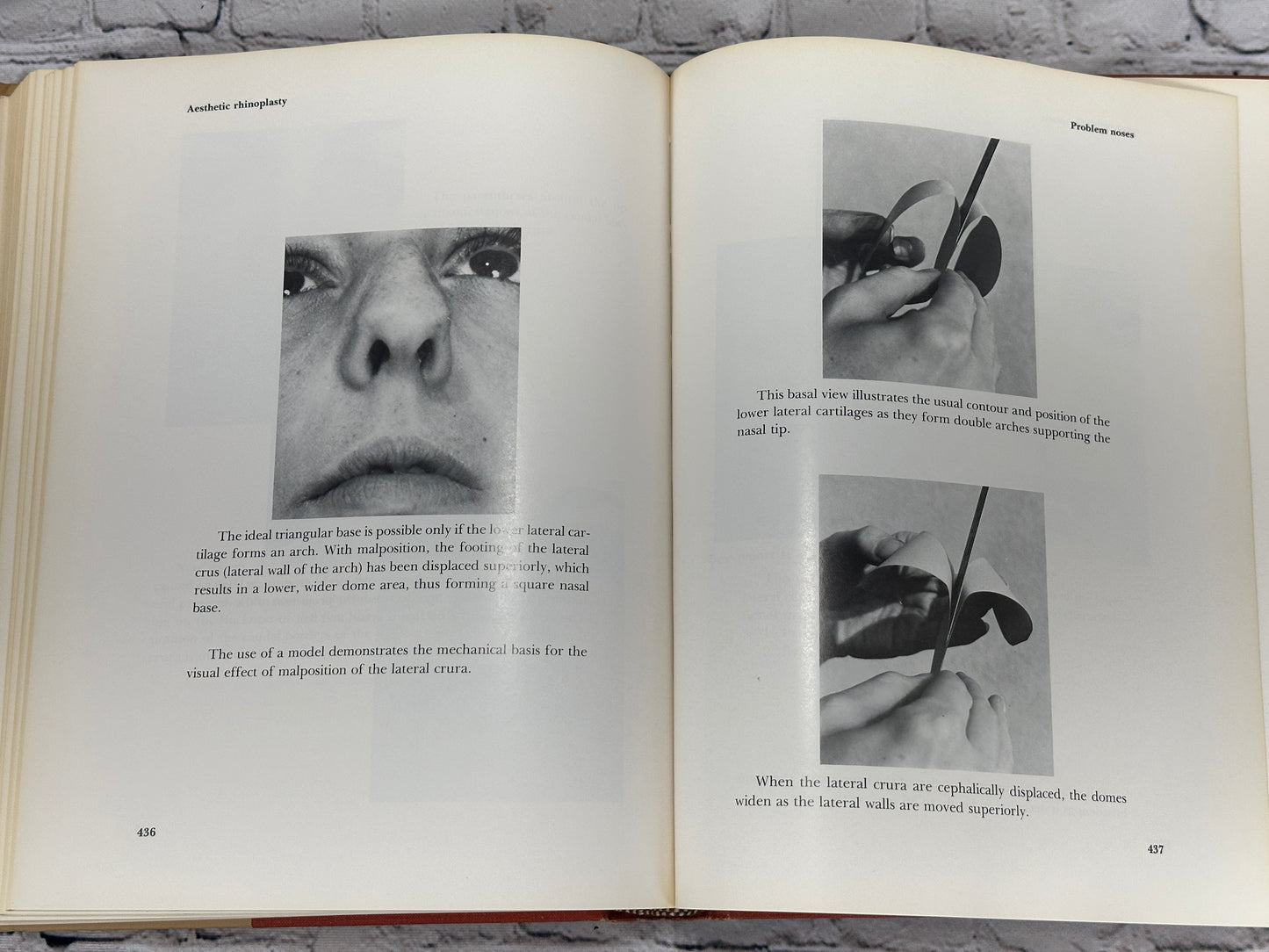 Aesthetic Rhinoplasty By Jack H Sheen [First Print · 1978]