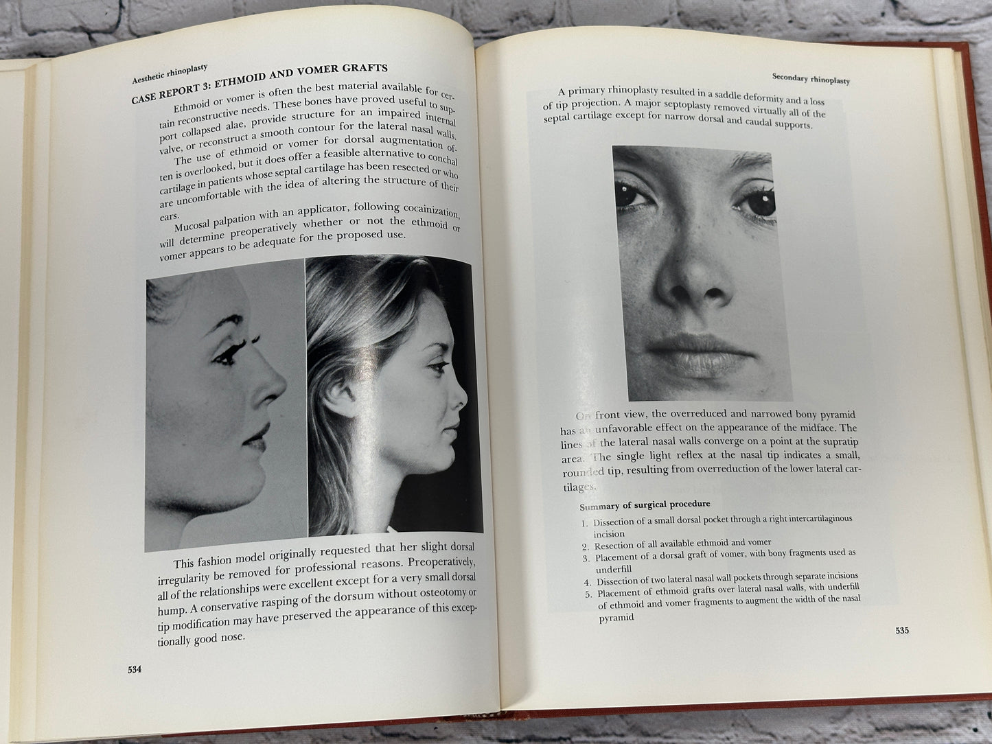 Aesthetic Rhinoplasty By Jack H Sheen [First Print · 1978]