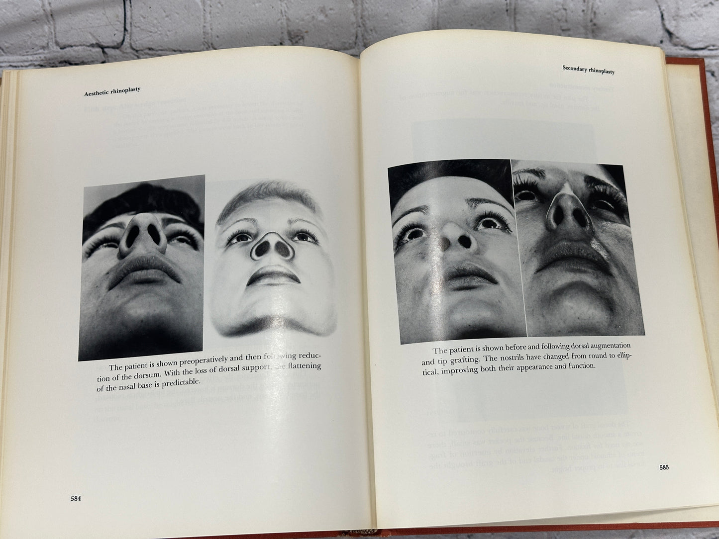 Aesthetic Rhinoplasty By Jack H Sheen [First Print · 1978]