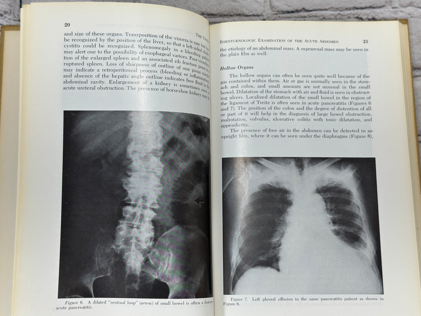 The Acute Abdomen [Major Problems in Clinical Surgery · Volume 10 · 1969]