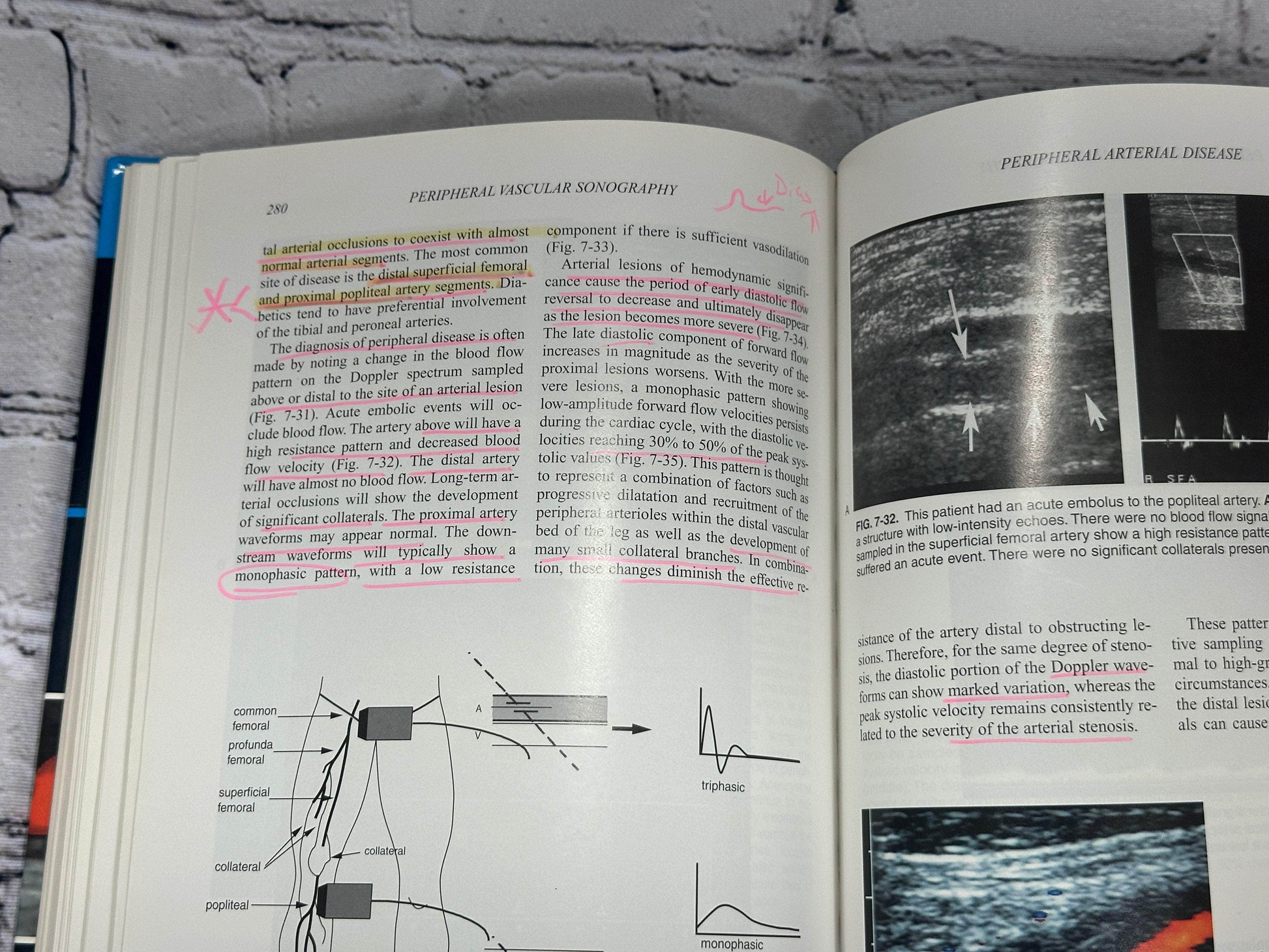 Flipped Pages Peripheral Vascular Sonography: A Practical Guide by Joseph Polak [2nd Edition]